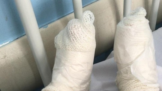 Criança sofre queimaduras graves nos pés após pisar em tampa de ferro superaquecida em creche