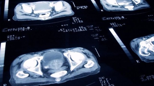 Estudo feito no Reino Unido mostra que doses de radioterapia para câncer de próstata podem ser diminuídas sem perder a eficácia