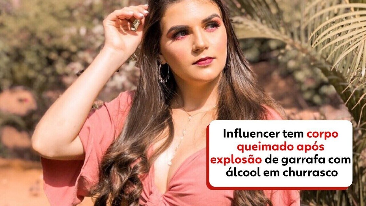 Influencer do ES que teve corpo queimado após explosão de garrafa com álcool em churrasco recebe alta da UTI