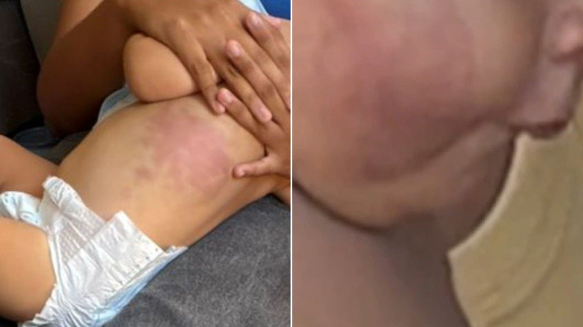 Bebê de 1 ano foi torturado em Arraial do Cabo por 15 dias, diz laudo; mãe e padrasto presos alegaram ataque de pitbull