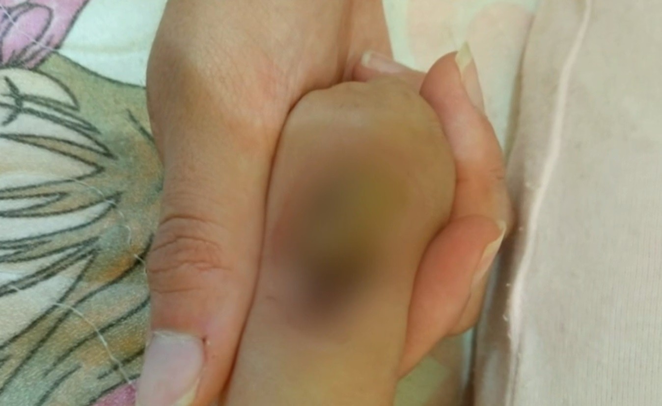 Bebê passa por enxerto na mão após lesão durante internação, e família denuncia negligência