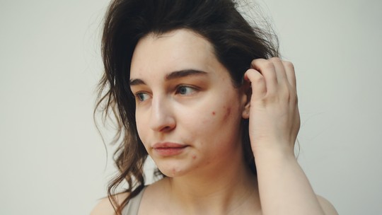 'Cirurgia da acne' x 'espremer espinhas': saiba o que faz mal na limpeza de cravos e espinhas - Profissionais alertam para riscos de infecção e cicatrizes; em casos raros, apertar lesões na face pode até causar meningite.