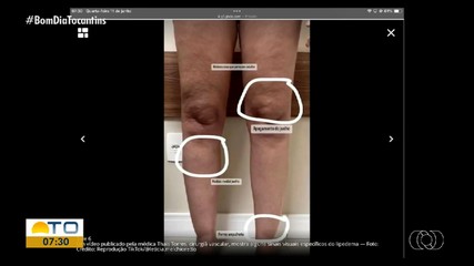 Telespectadores tiram dúvidas sobre lipedema com médica no Bom Dia Responde