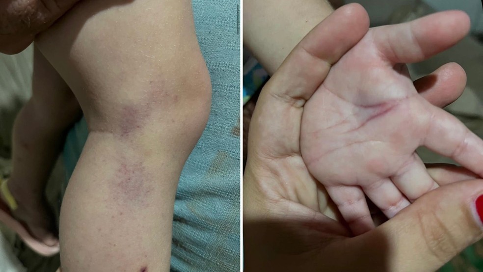 Mãe denuncia creche após bebê de 1 ano ter nariz quebrado e hematomas em Valentim Gentil (SP) — Foto: Arquivo pessoal