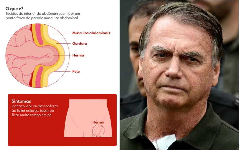 Infográfico mostra hérnia de Bolsonaro — Foto: Editoria de Arte/g1; Pablo Porciuncula/AFP