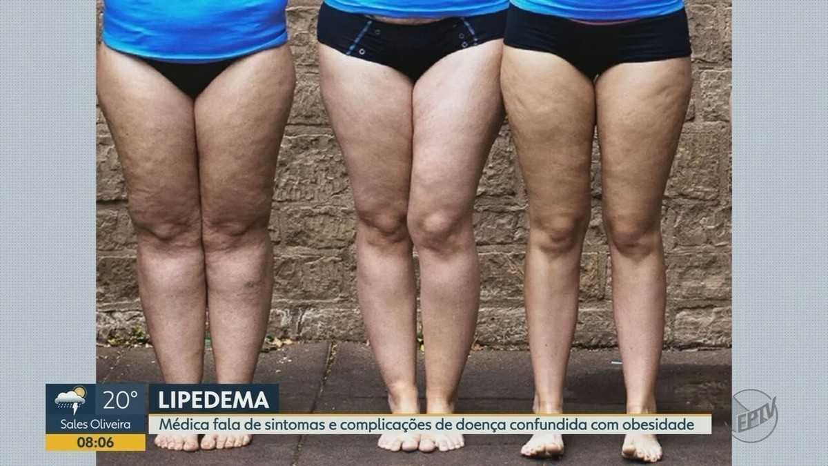 Lipedema: Entendiendo la enfermedad que provoca acumulación de grasa y se confunde con la obesidad |  Ribeirao Preto y Franca