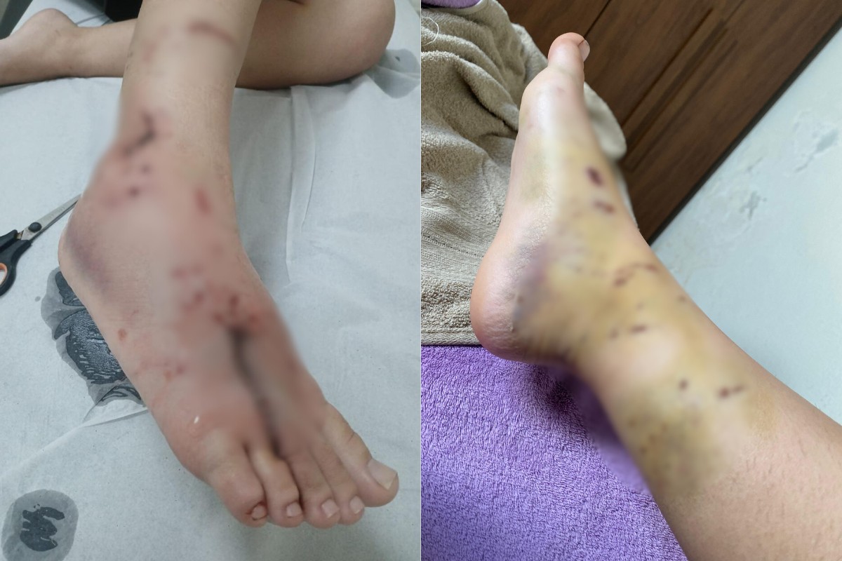 Jovem fica ferida ao tentar proteger cadela de ataque de outro cachorro: 'Não sei nem explicar o tamanho da dor'