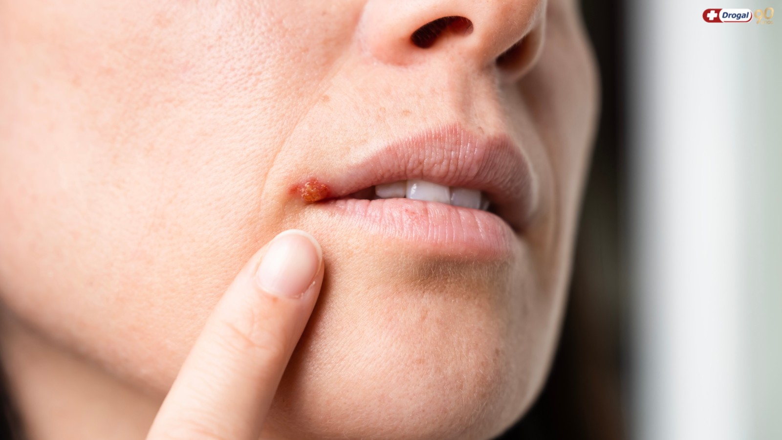 Transmissão do herpes zoster: como acontece e por que se proteger