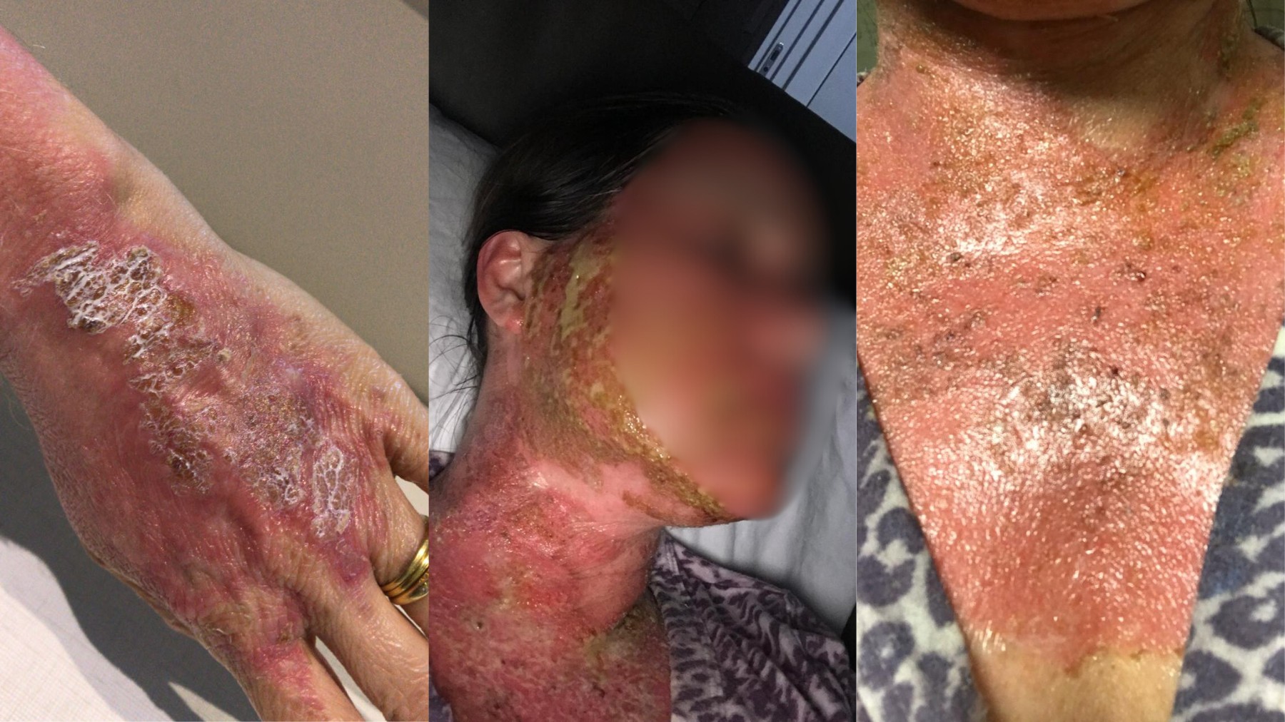‘Poderia ter morrido’, diz mulher que sofreu queimaduras graves após peeling feito por farmacêutico no Paraná
