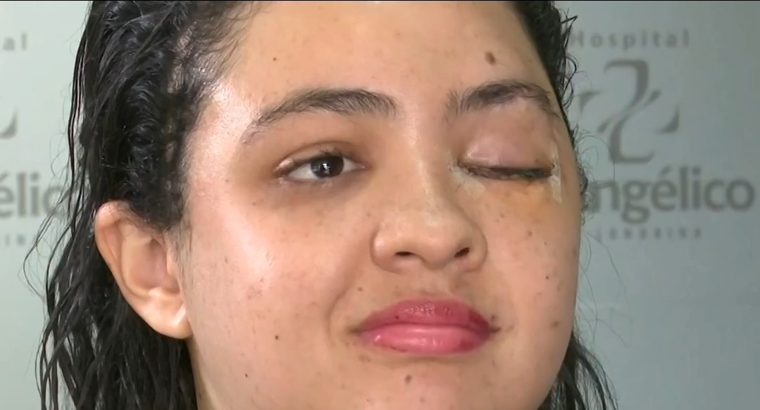 Titânio em cirurgias: entenda como o metal ajudou na inédita reconstrução  de face da mulher atropelada por colheitadeira no Paraná