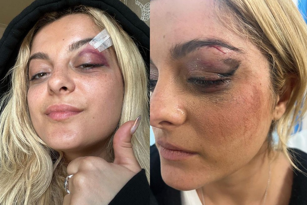 Bebe Rexha é atingida por celular durante apresentação e mostra foto com corte no supercílio — Foto: Reprodução/Instagram