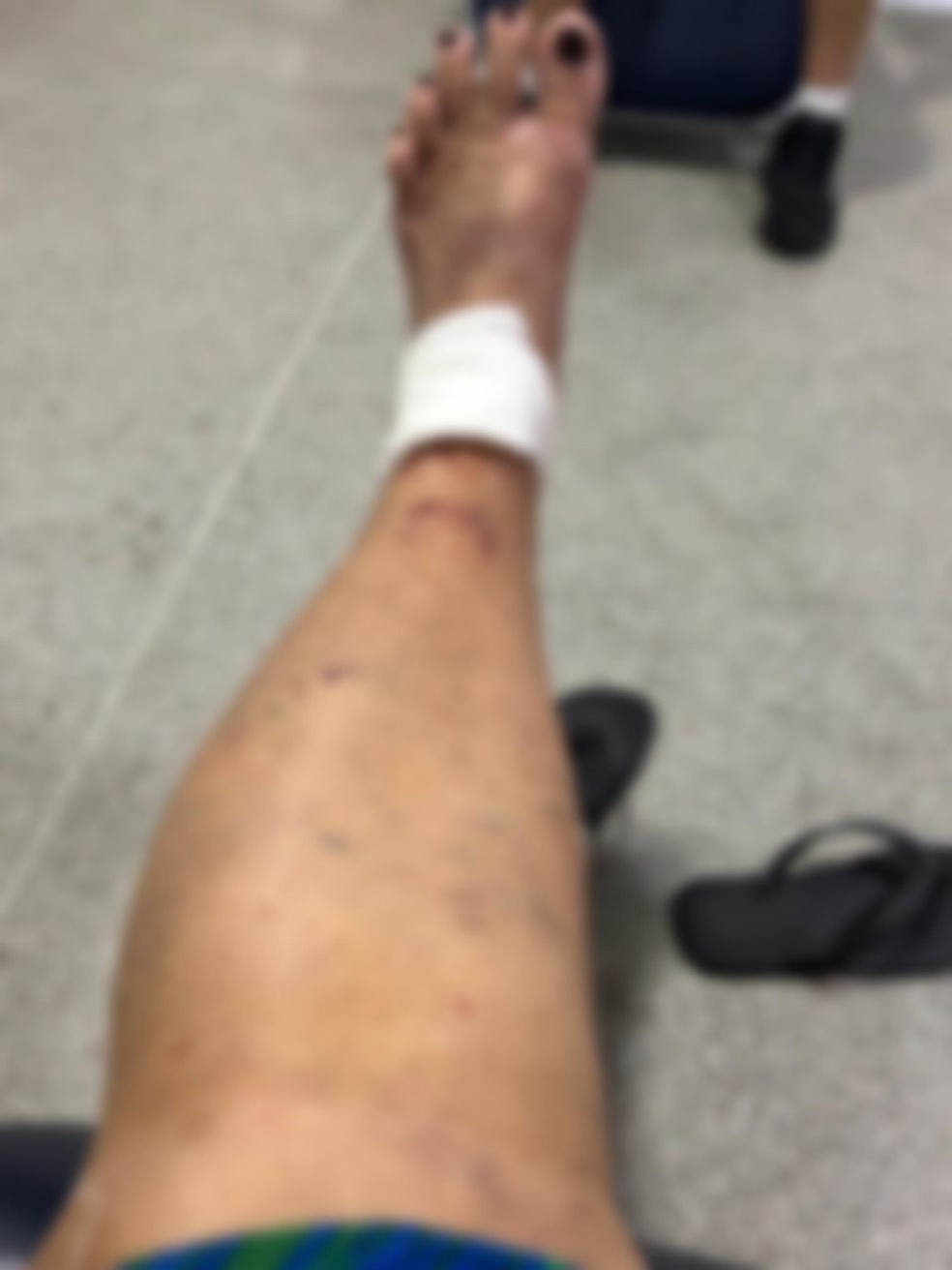 Turista de 70 anos perdeu os movimentos dos dedos após ser atacada por três cães enquanto caminhava pela orla de Paripueira. — Foto: Arquivo Pessoal