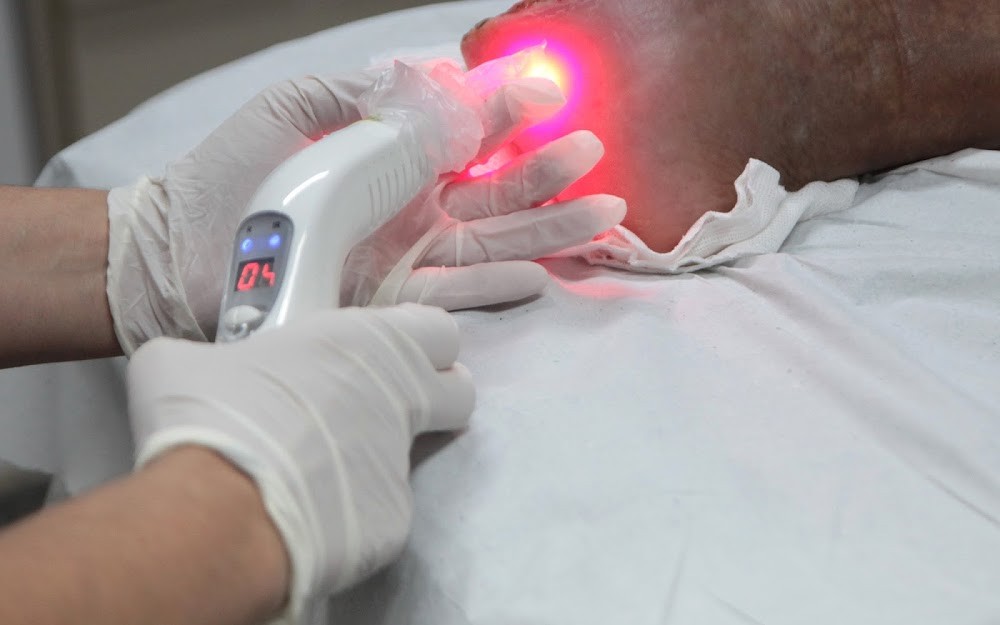 De cicatrização a queda de cabelo: entenda para que serve a laserterapia e quando ela é indicada