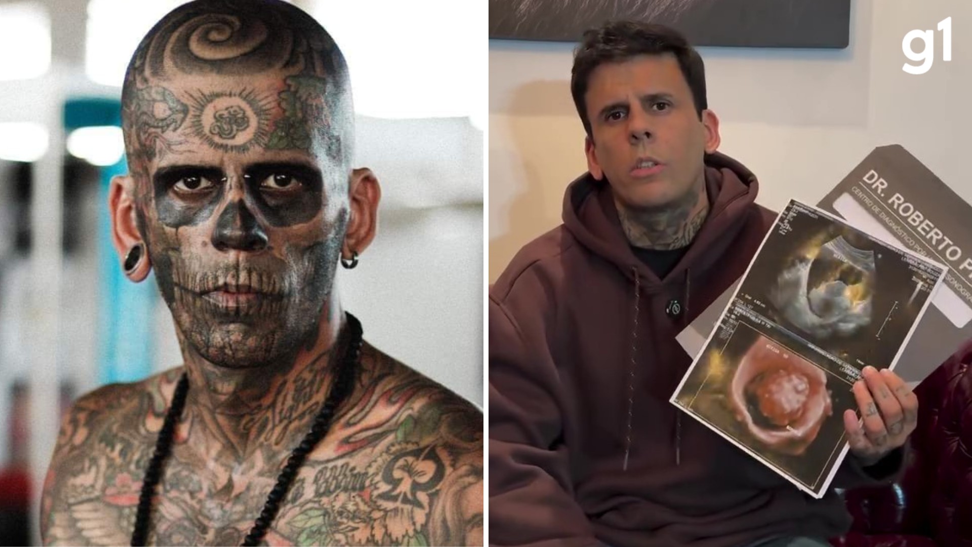 'Homem mais tatuado do Brasil' descobre tumor na bexiga horas antes de nova sessão de remoção de tatuagens