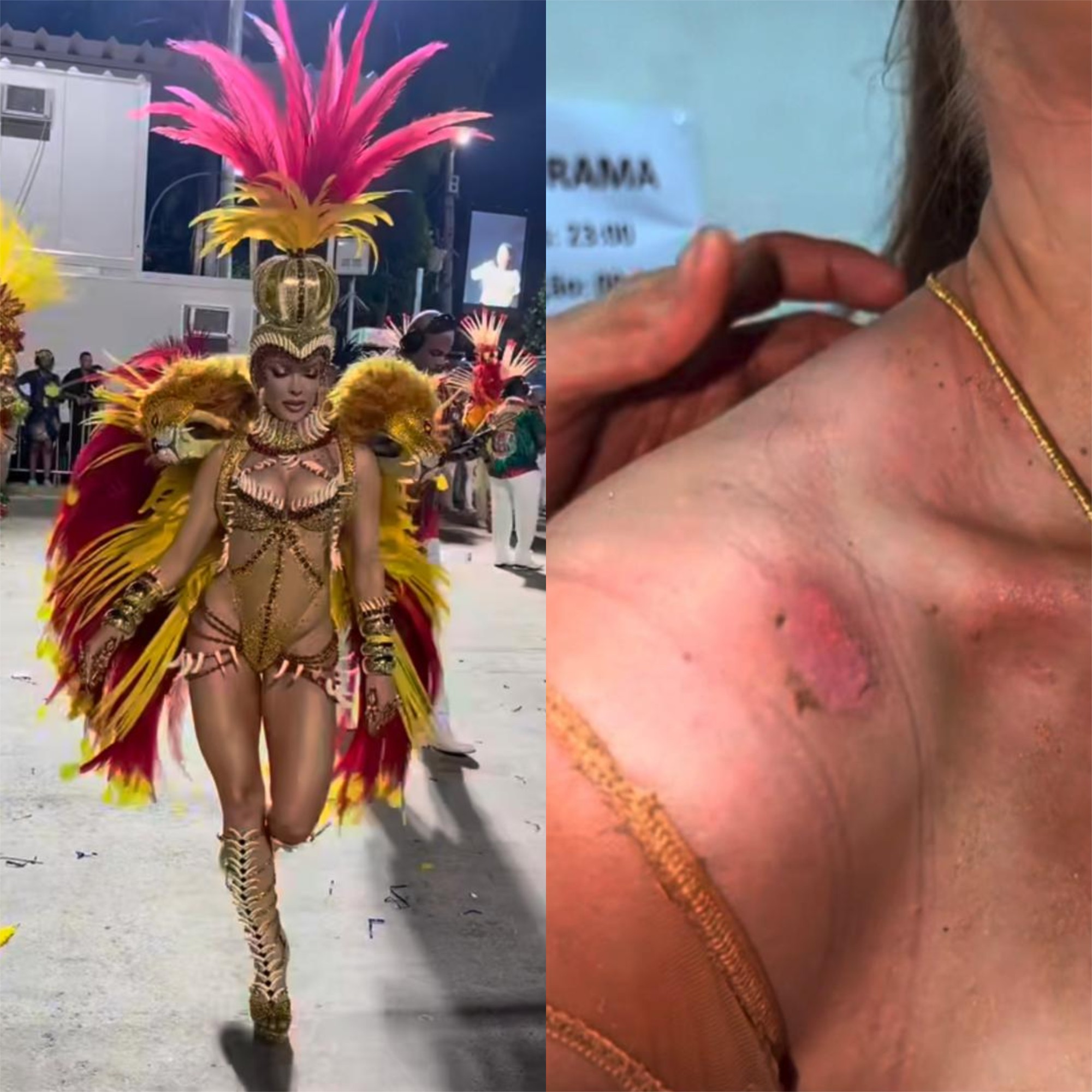 Musa da Grande Rio, Jaquelline Grohalski mostra ombro 'em carne viva' após desfile 