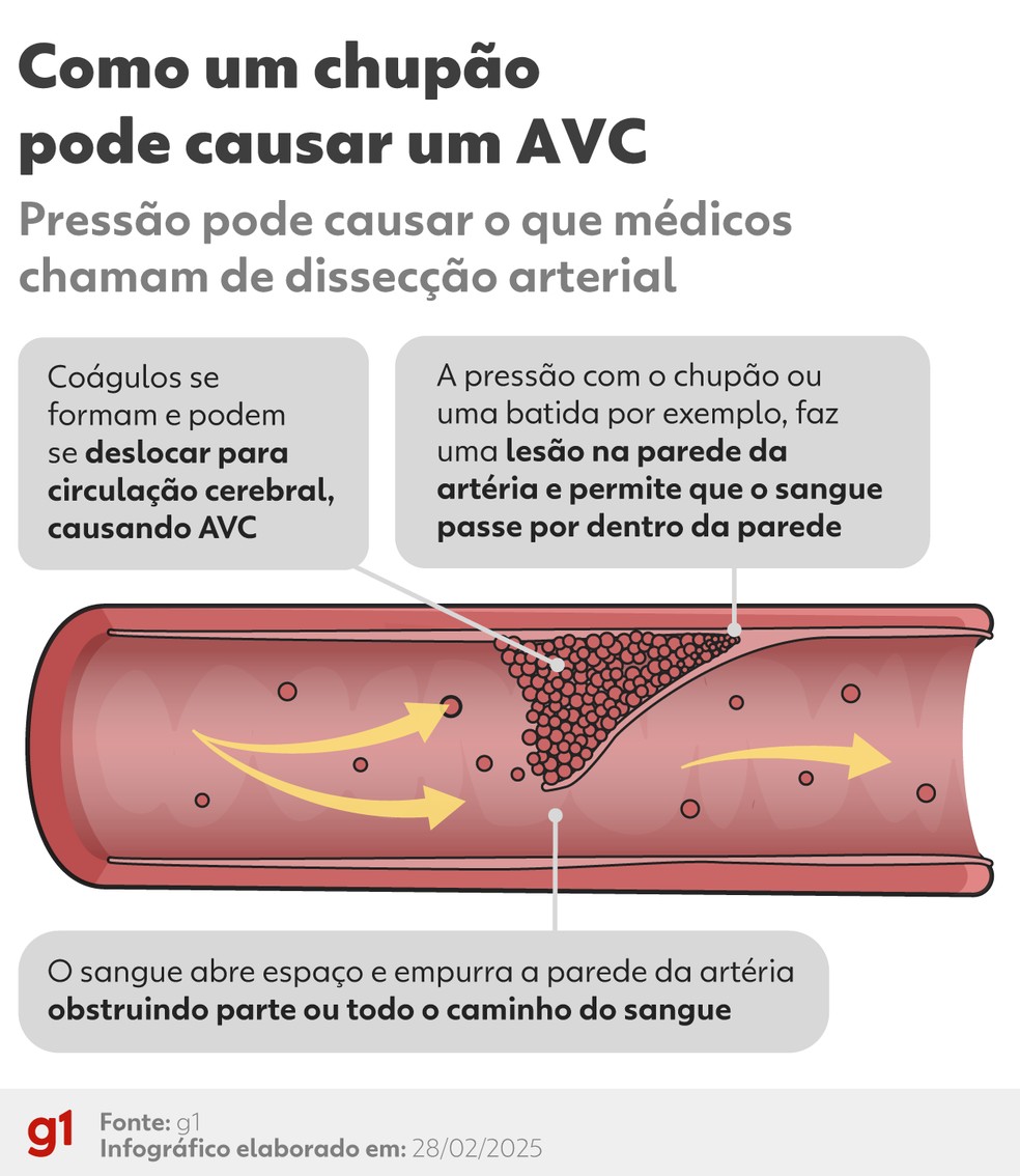 Arte explica como chupão acabou levando a um AVC — Foto: Arte/g1