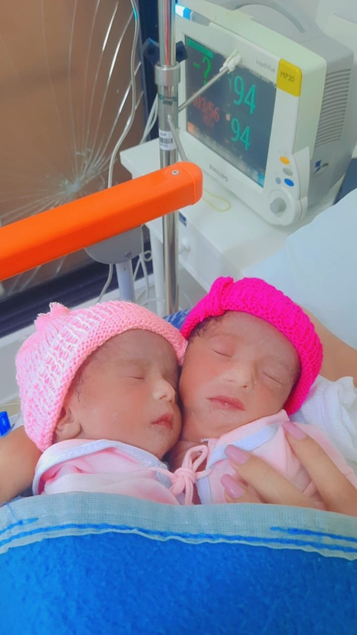 Gêmeas siamesas ligadas por um só coração nascem prematuras: 'Feliz, mas preocupado', diz pai