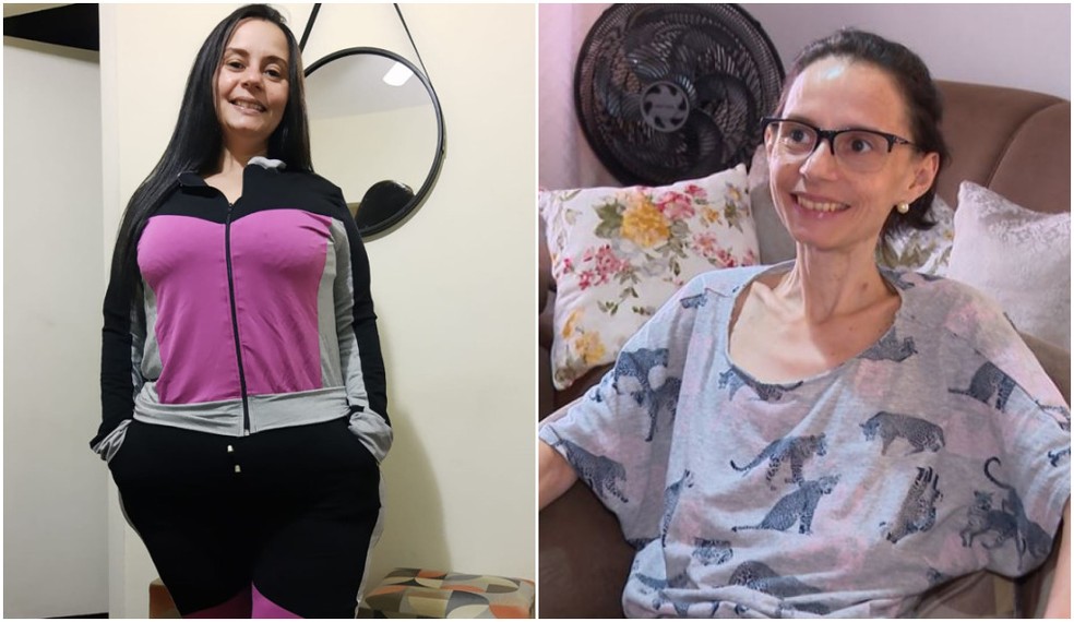 Ana Paula Santana da Cunha, perdeu 60 kg dos 96 kg que tinha após fazer uma cirurgia bariátrica e ficou com anemia severa — Foto: Arquivo pessoal