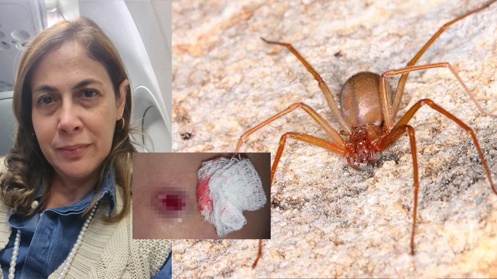 Dentista picada por aranha-marrom relata dor e longo tratamento; Brasil registra mais de 20 mil acidentes em 2025