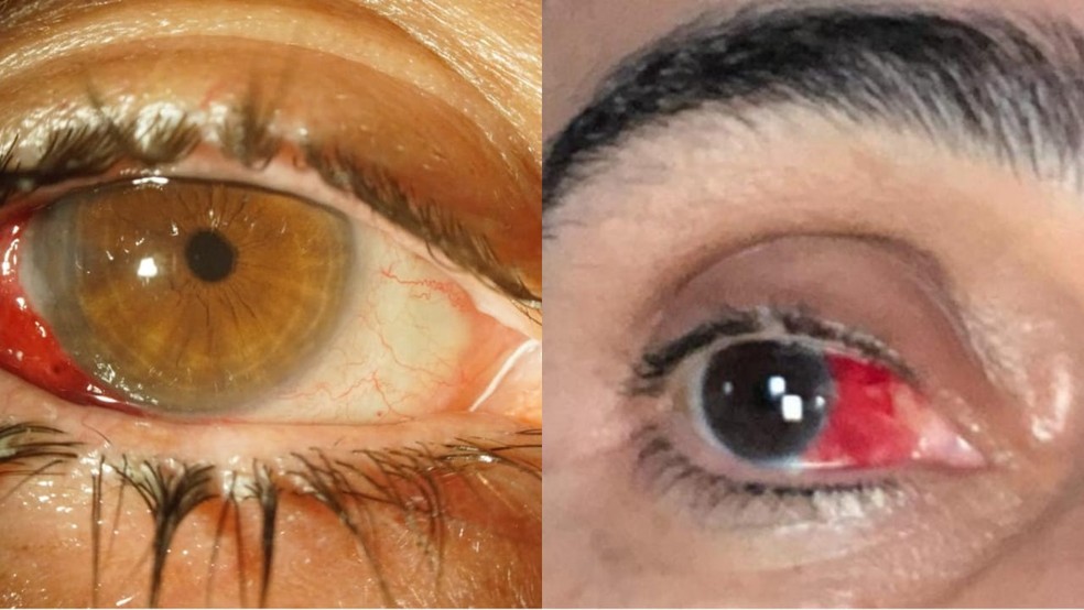 Tata Estaniecki mostra como está o olho 10 dias após derrame ocular