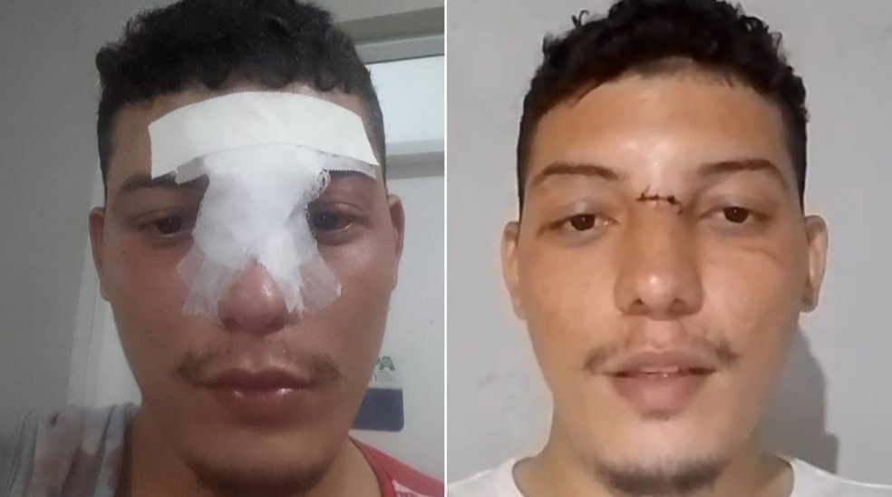 Vitor Borges teve que passar por uma pequena cirurgia no rosto após ser atingido por linha com cerol na Grande Fortaleza. — Foto: Reprodução/TV Verdes Mares