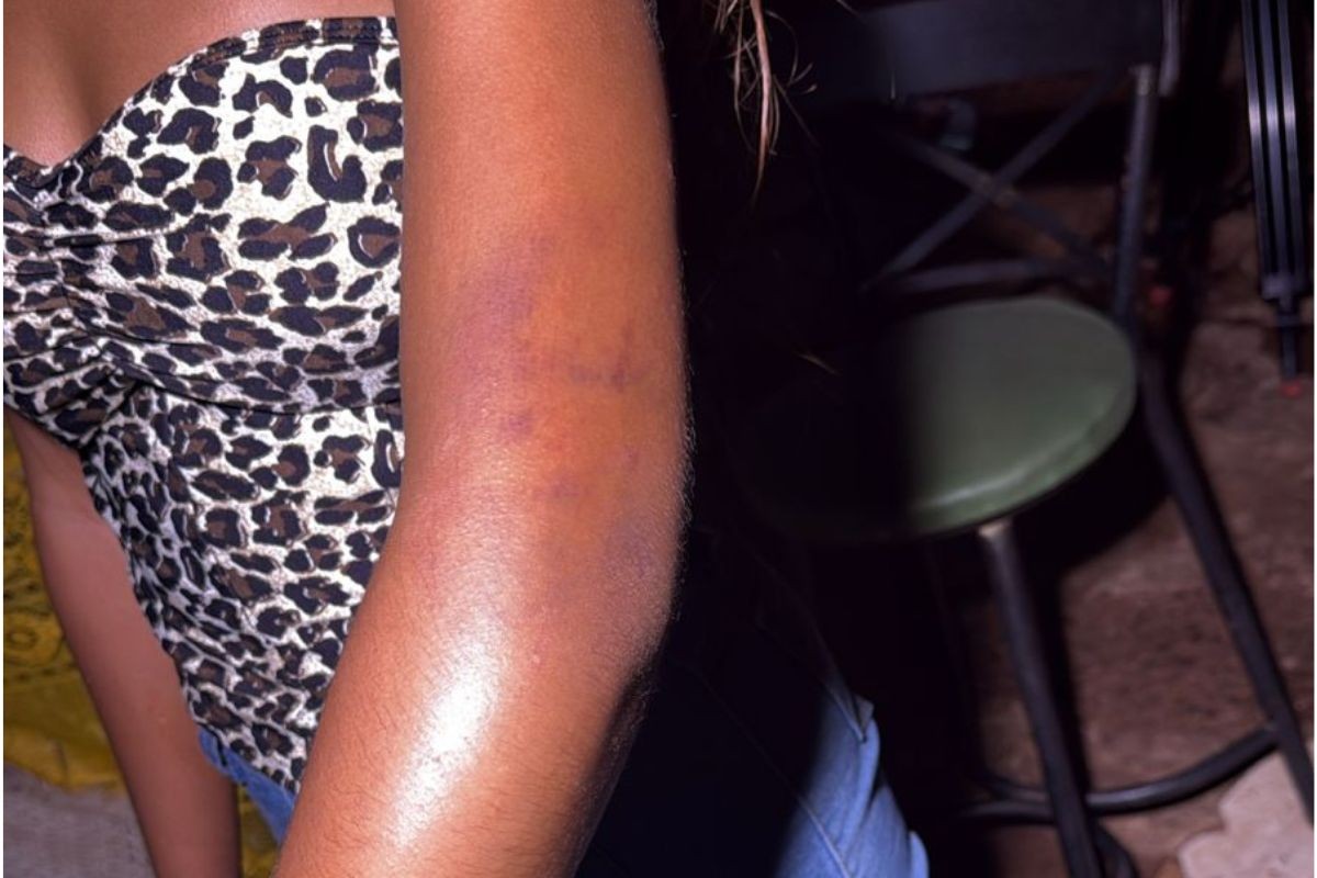 Menina de 15 anos agredida por PM diz sentir dores e que não recebeu ajuda após agressão no Carnaval