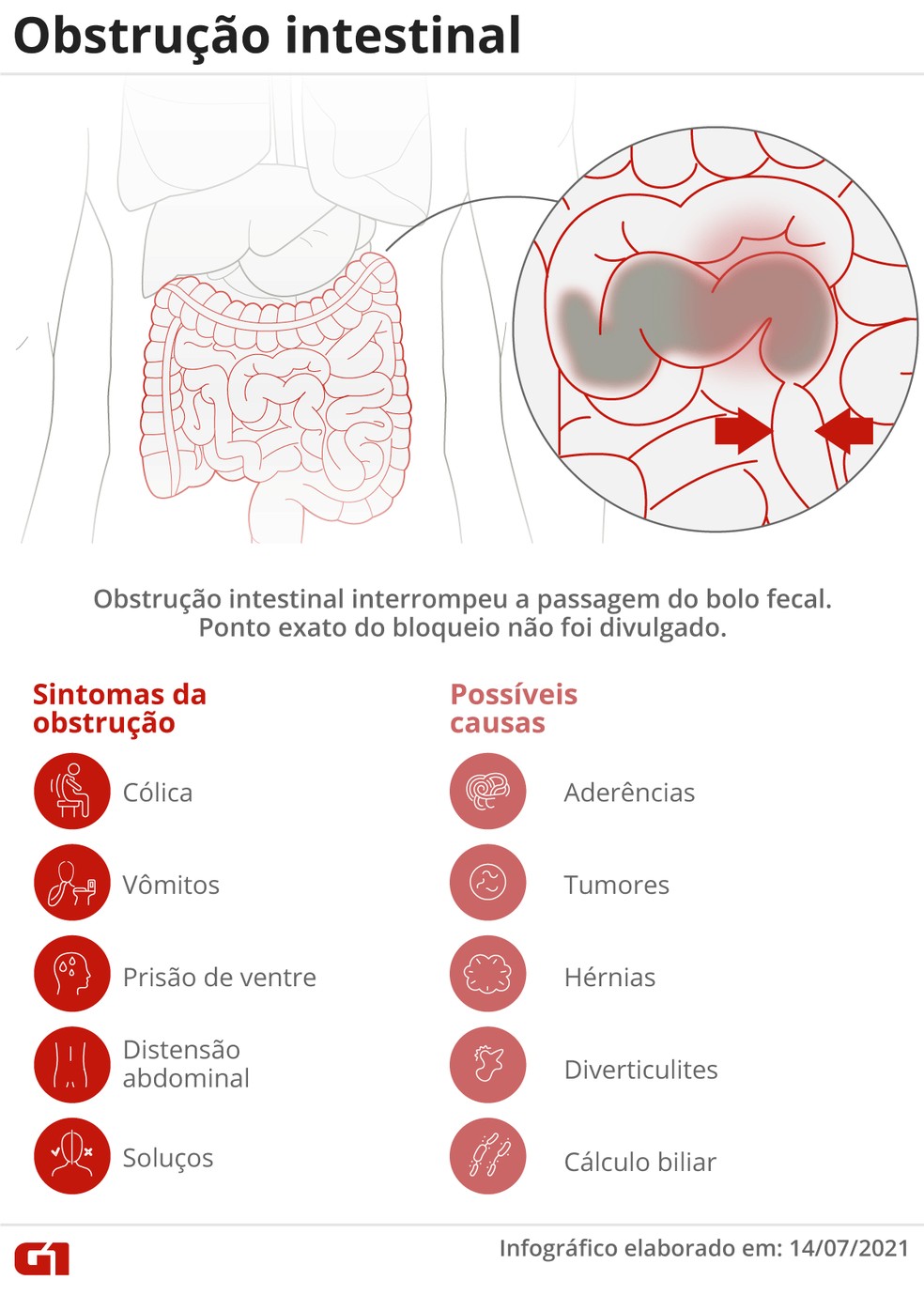Obstrução intestinal: entenda o quadro de Bolsonaro — Foto: Arte/G1