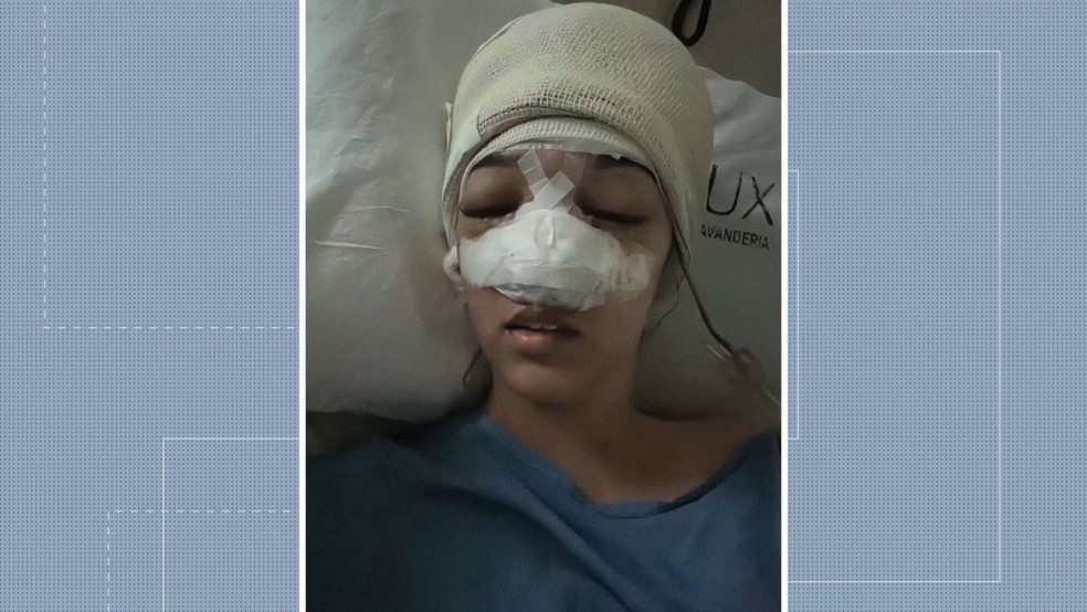 Michaella Zukowski Reis, advogada de 25 anos, atingida por paralelepípedo em rodovia do ES, após cirurgia de reconstrução do rosto.  — Foto: Reprodução/TV Gazeta