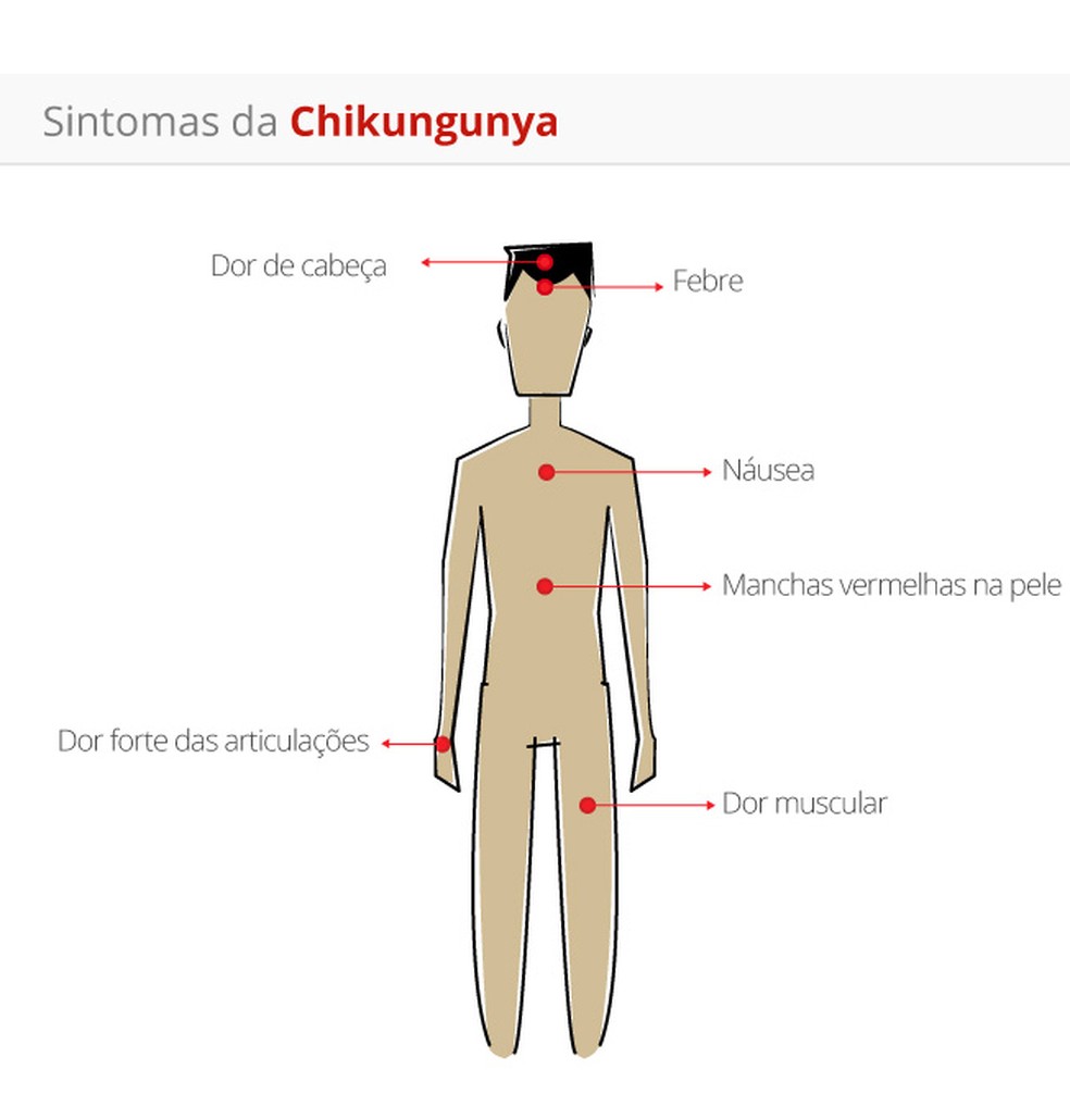 chikungunya sintomas — Foto: Arte/G1