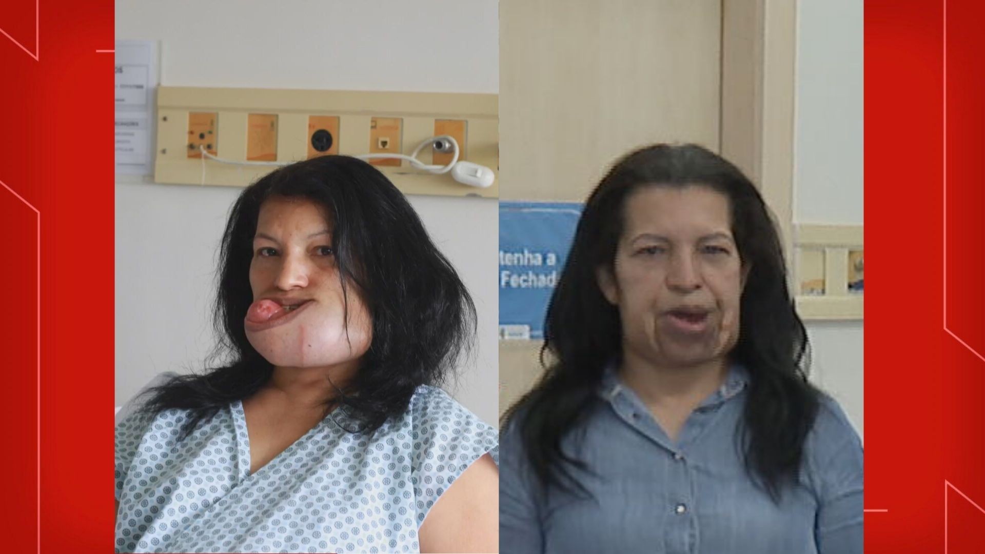 Há 15 anos com tumor raro, mulher opera boca e volta a sorrir no DF