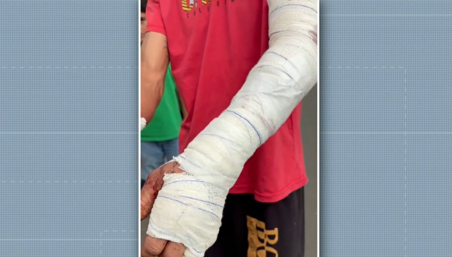 'Foi só Deus mesmo para separar de mim', diz pedreiro atacado por pitbull em Piracicaba