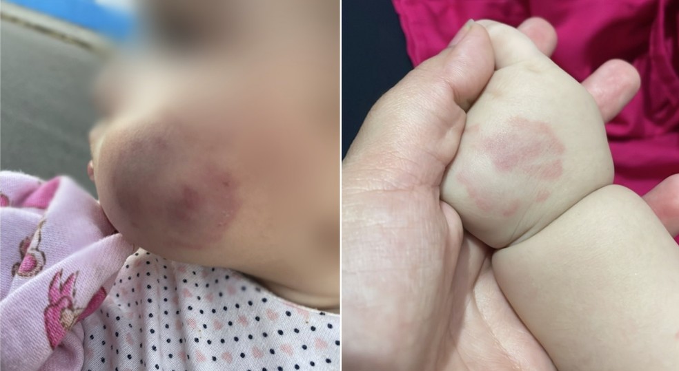 Vanessa Raaby foi pegar a filha de oito meses na escola e a viu com vários hematomas. — Foto: Reprodução