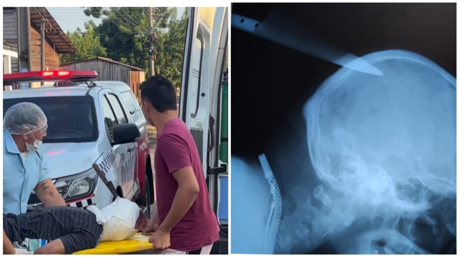 Homem tem faca cravada na cabeça após cobrar dívida em Monte Alegre, no PA