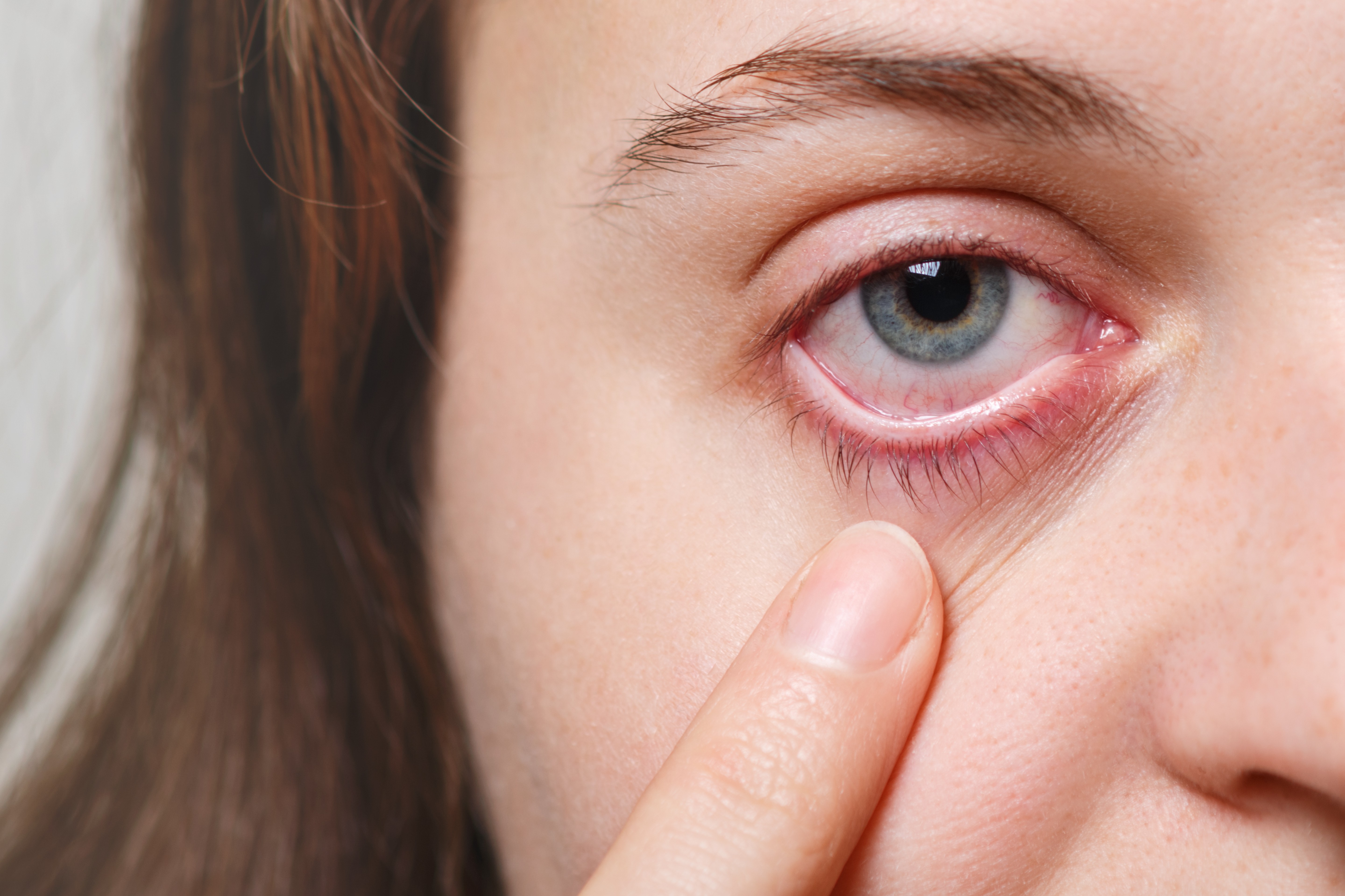 Você já ouviu falar em pterígio e ceratocone? Veja como evitar complicações