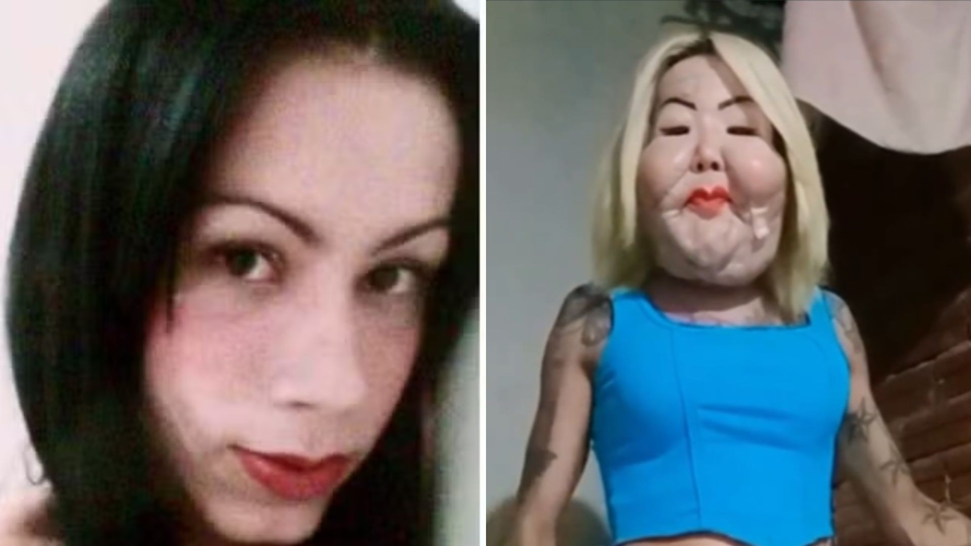 Juju do Pix mostra como está seu rosto 50 dias após cirurgia para retirar óleo mineral; veja antes e depois