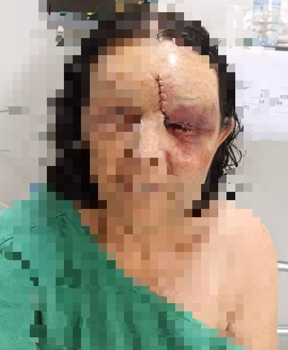 Sogra fica com rosto desfigurado ao defender a filha agredida por marido embriagado em MG 