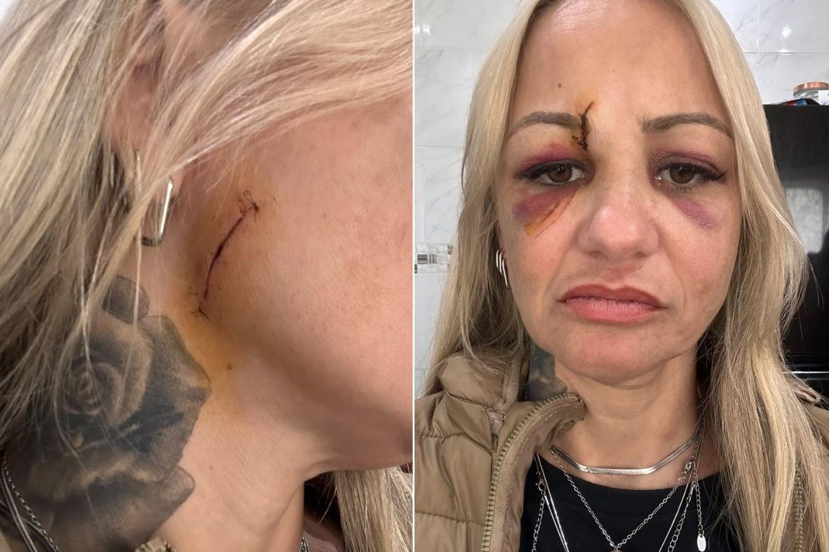 Cabeleireira leva pontos no rosto após ser agredida com taça de vidro na saída de bar no litoral de SP