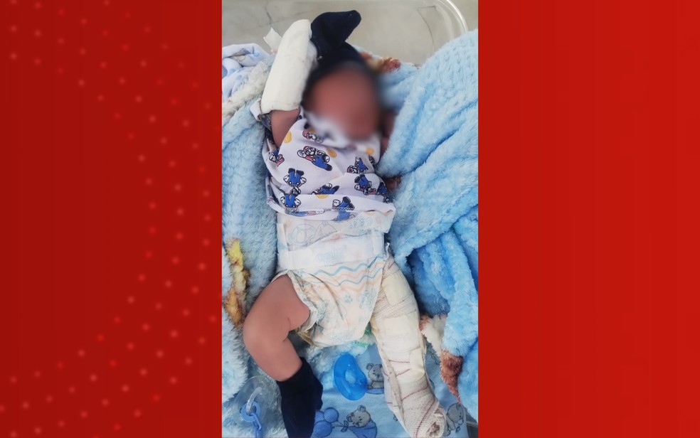 Bebê com perna engessada após fêmur quebrar em parto na RMS — Foto: Redes sociais