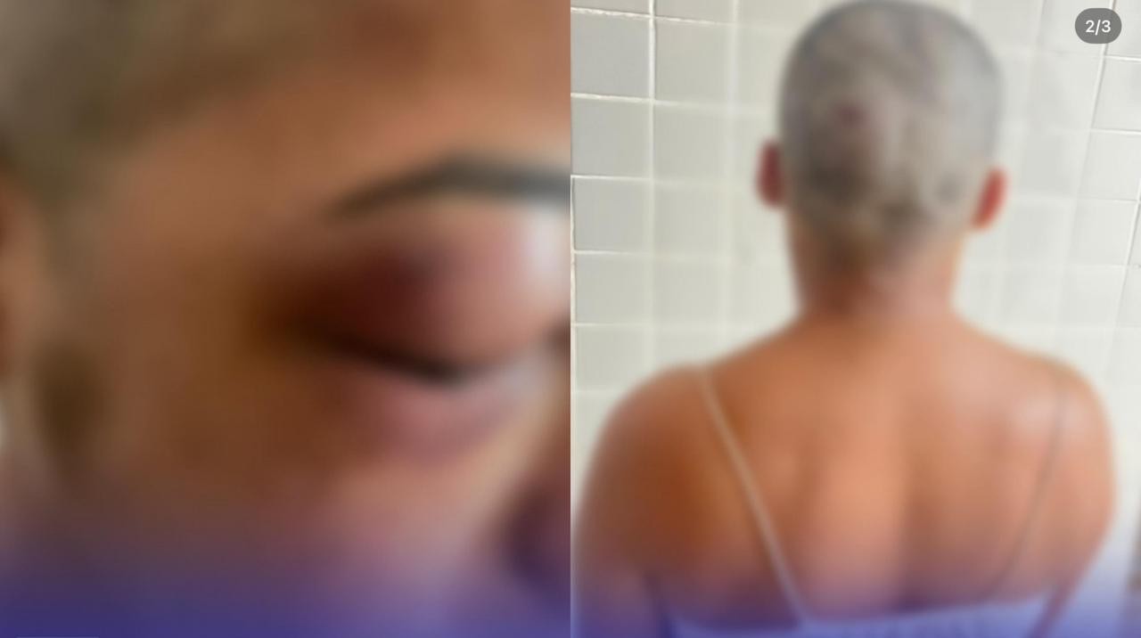 Mulher tem cabelo raspado após agressão e dias depois sofre atentado a tiros em Almeirim, no Pará