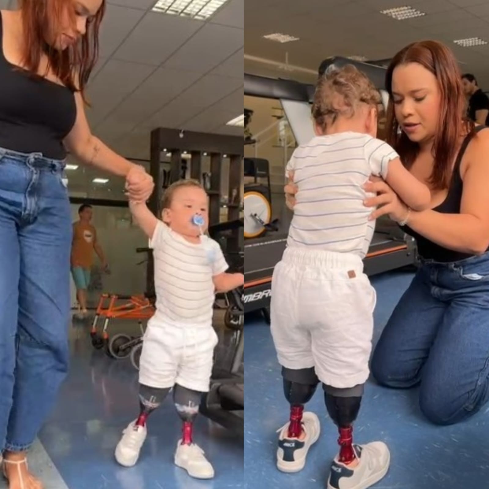 Após desvio de doações pelo pai, criança amputada ganha próteses e começa a caminhar