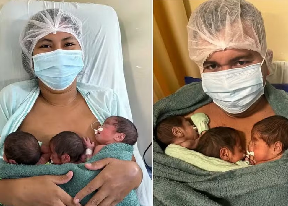 
Quando o ultrassom erra a conta: mãe descobre trigêmeos na hora do parto, no Pará