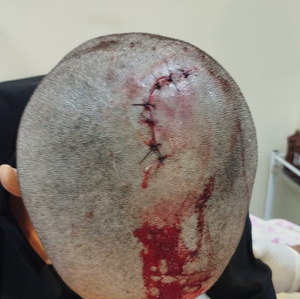 Mulher levou sete pontos na cabeça após ter cabelo raspado e ser espancada pelo ex-marido — Foto: Deam/Divulgação