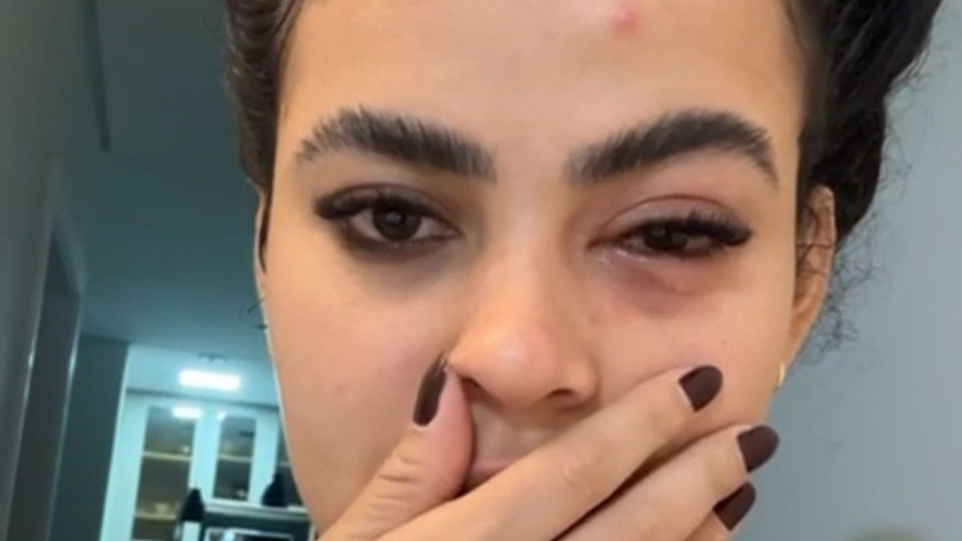 Influenciadora viraliza após infecção por mosca de banheiro no ES
