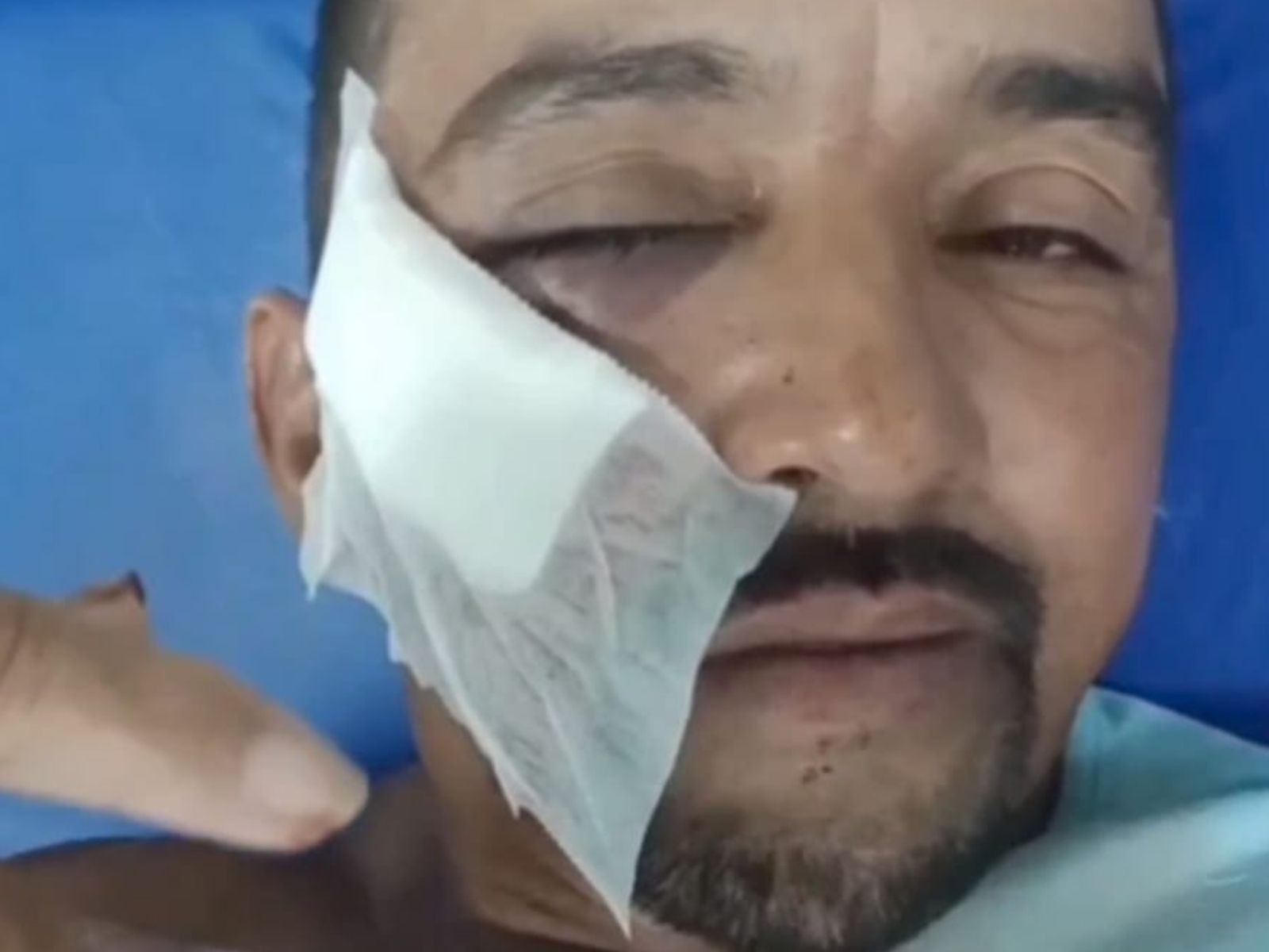 Gari é atingido com tijolada no rosto ao se recusar recolher garrafa no Acre: 'Quebrou um osso'