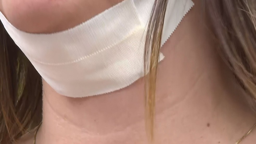 Mulher teve complicações após procedimento de lipo de papada — Foto: TV Globo/ Reprodução