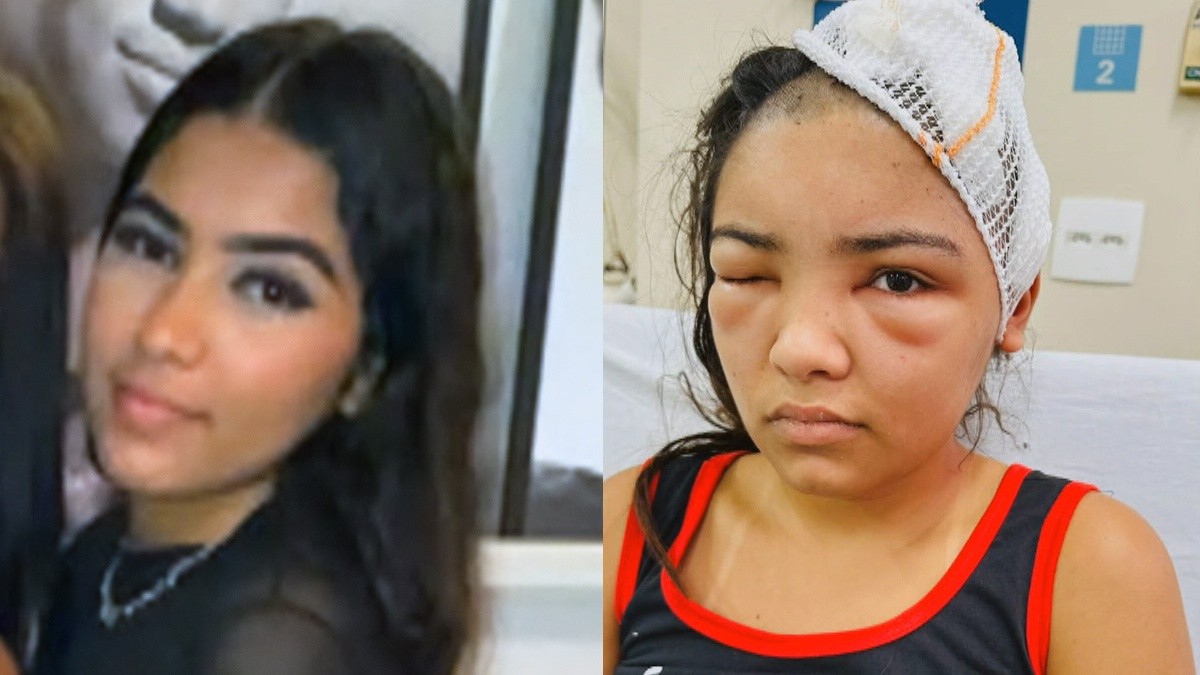 Jovem é baleada na cabeça durante encontro; vítima perdeu a memória, diz família