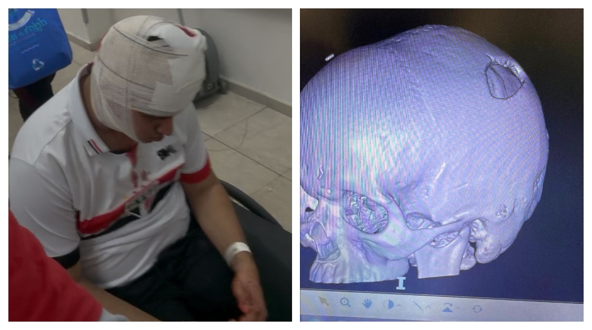 Justiça manda São Paulo e Conmebol pagarem pensão de R$ 8 mil a torcedor atingido por placa de metal