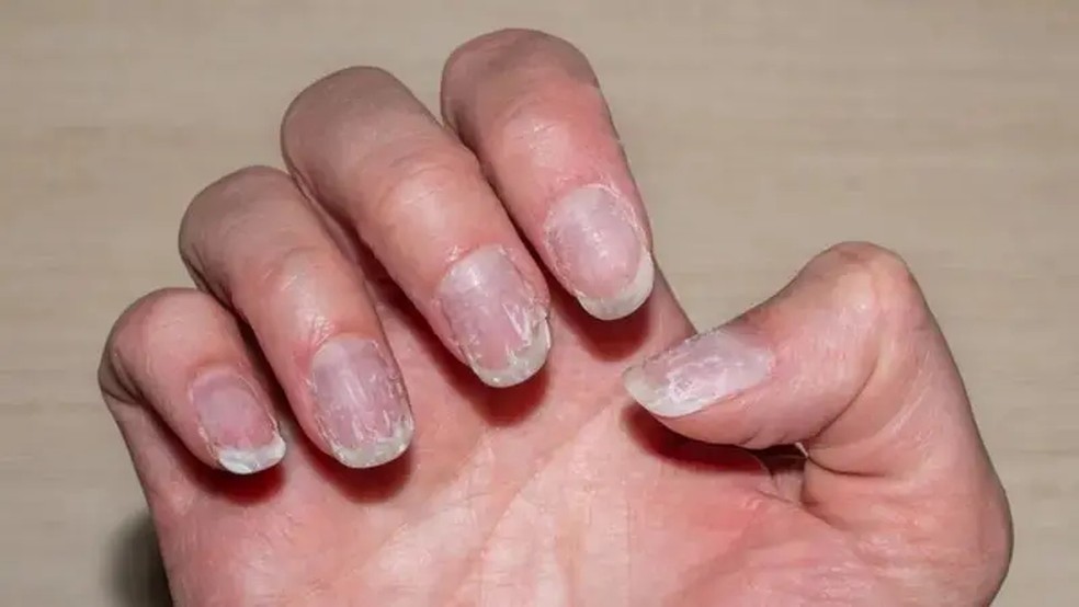 A causa mais frequente é o contato com produtos químicos e que ressecam a parte das unhas e dedos — Foto: Getty Images via BBC