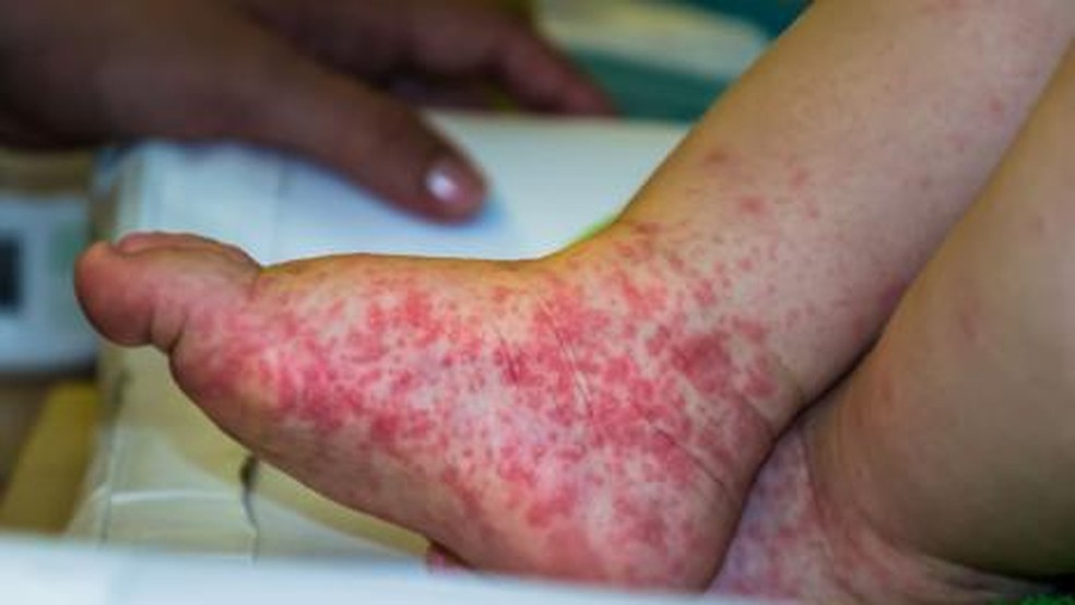 'Gripe do tomate' tem sintomas semelhantes aos da síndrome 'mão-pé-boca'. — Foto: Divulgação/Prefeitura de Araguaína