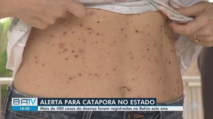 Conselho Estadual de Saúde da Bahia atribui aumento de casos de catapora no  estado a baixa cobertura vacinal, Bahia